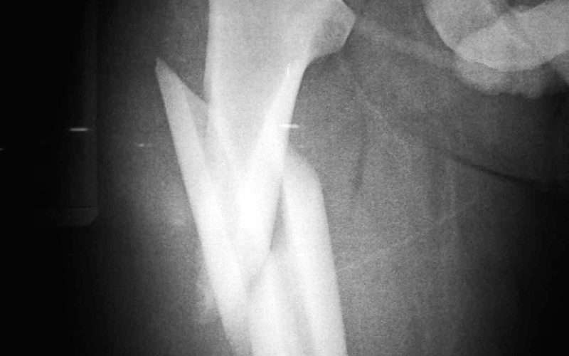 Por qué se producen las fracturas