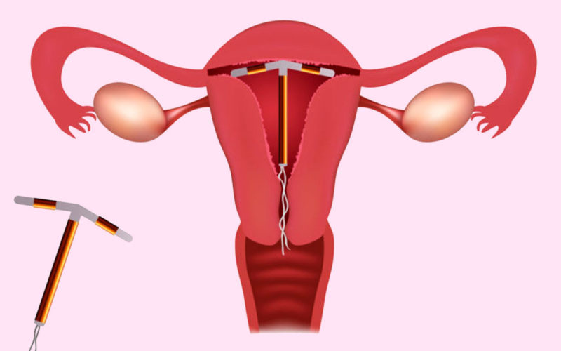 Qué métodos se utilizan para controlar la natalidad