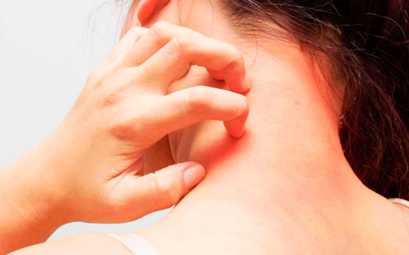 Qué tipos de alergia hay